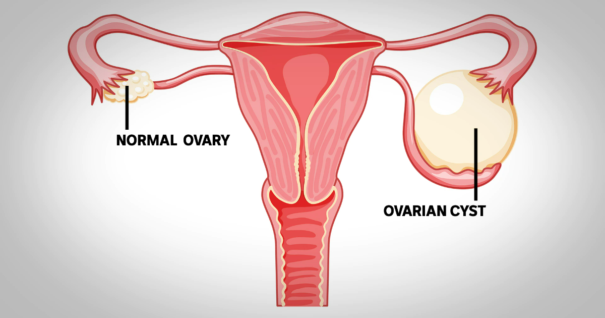 Lily lost her ovary to a cyst the size of a grapefruit. What's the deal